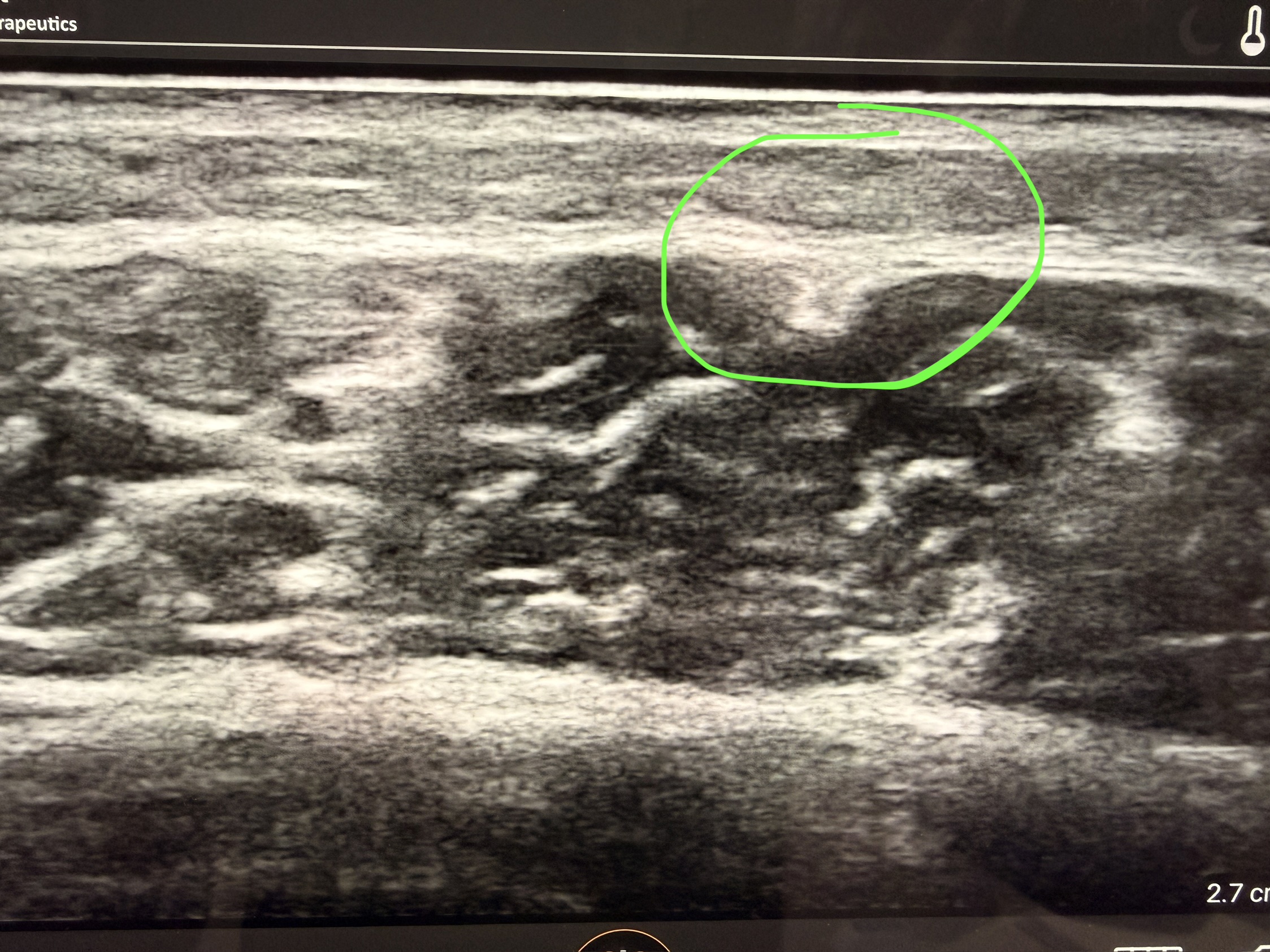 Calf fascial adhesion